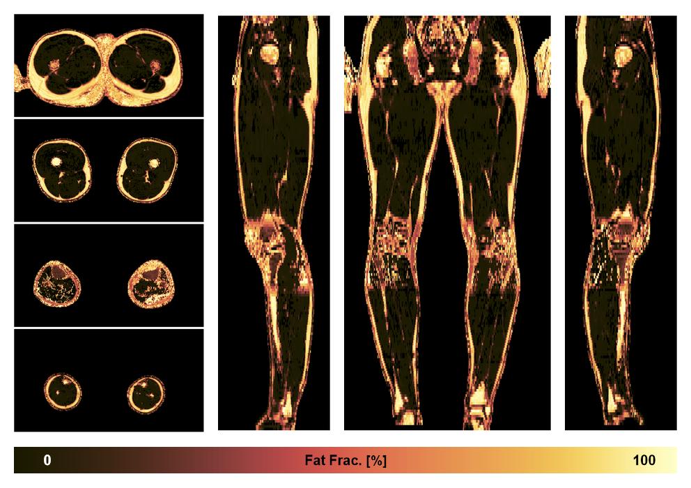 The fat fraction of the lower extremity obtained from the dixon reconstruction for muscle water fat quantification.